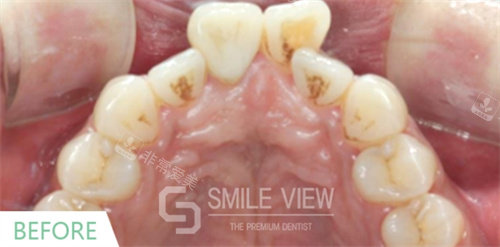 韓國SMILE VIEW牙科牙齒矯正前 韓國SMILE VIEW牙科牙齒矯正前