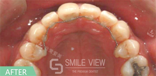 韓國SMILE VIEW牙科牙齒矯正后 韓國SMILE VIEW牙科牙齒矯正后