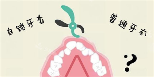 傳統(tǒng)牙套和自鎖牙套動畫圖