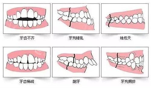 牙齒矯正手術(shù)使用情況動(dòng)畫演示圖