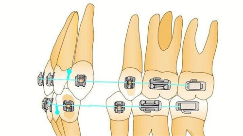 牙齿矫正原理动画演示图