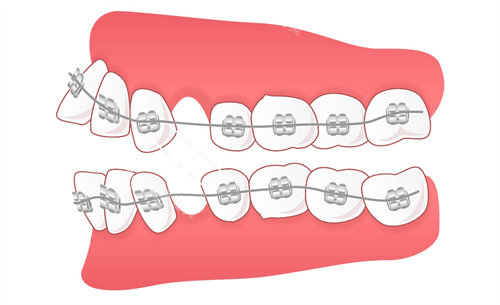 陶瓷牙套矫正演示图