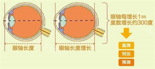 眼轴长度与近视