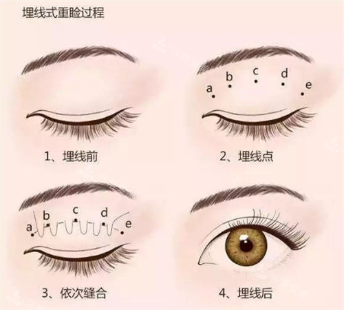 双眼皮手术过程图