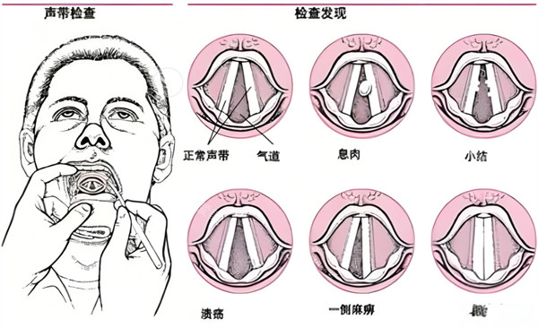 声音整形图示