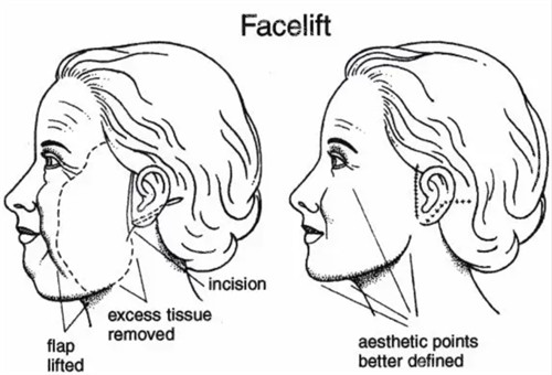 面部提升改善皮肤下垂等问题