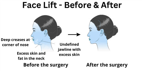 面部提升前后下巴及皮肤的改善对比