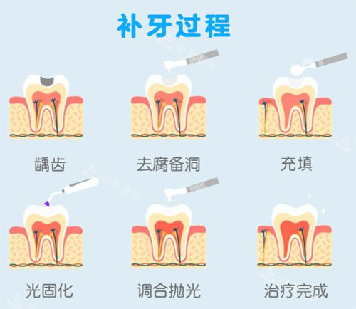 補(bǔ)牙過程動(dòng)畫演示圖