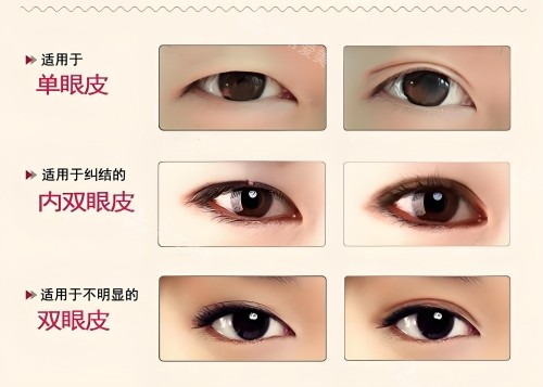 適合哪種雙眼皮手術(shù)