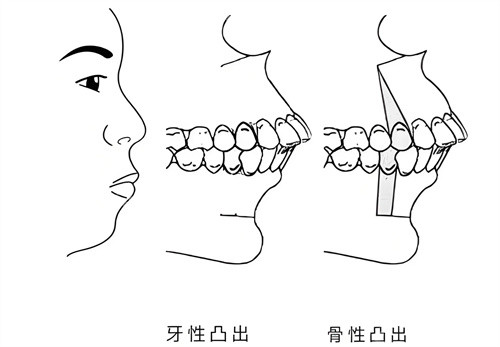 牙性突出和骨性突出對(duì)比圖