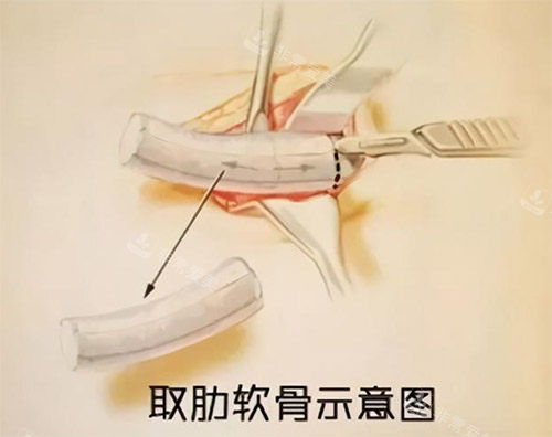 肋骨鼻手术过程图