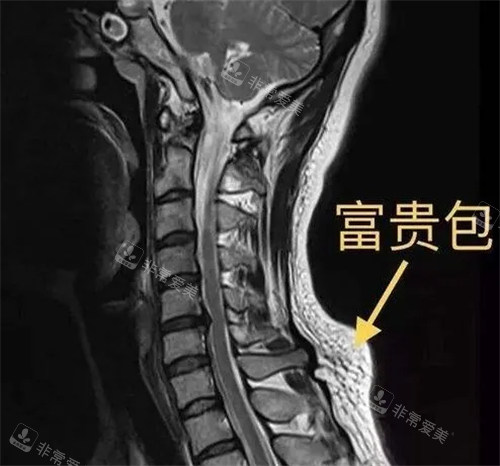 CT下的富贵包图示