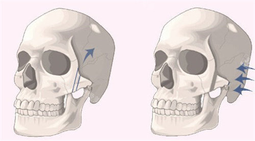 3d颧弓旋转和颧骨内推对比