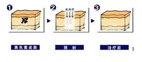 激光祛雀斑的過程