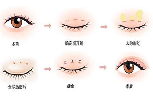 西安眼综合医生推荐：速看孙峰/鲁礼新/刘恒鑫/徐文云哪个医生做得好?