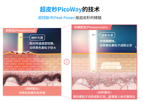 韓國(guó)麗優(yōu)美皮膚科超皮秒優(yōu)勢(shì)