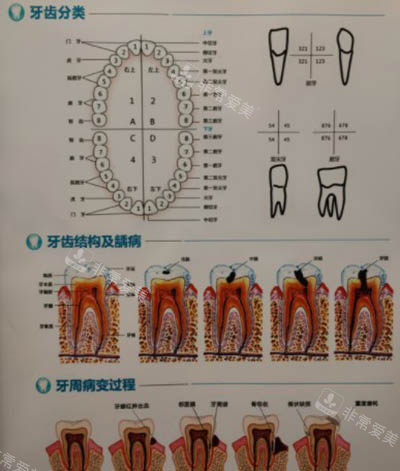 牙齿龋坏发展过程图