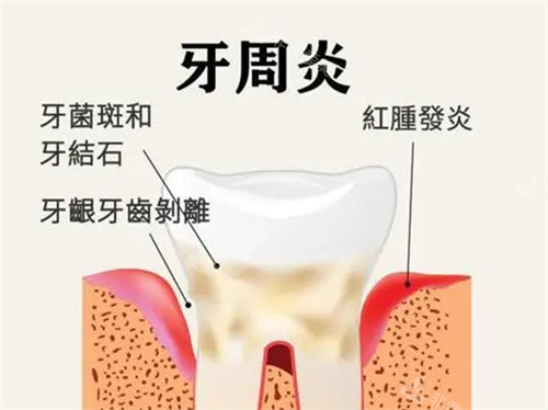 牙周炎漫画示意图