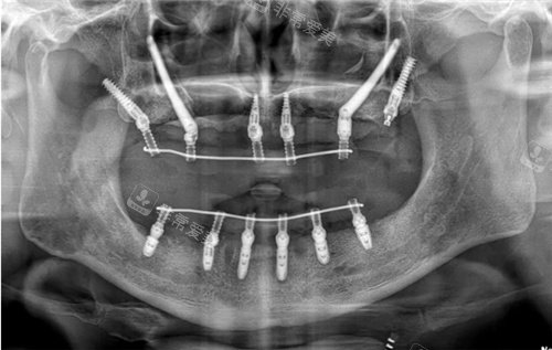 穿颧穿翼种植牙图示