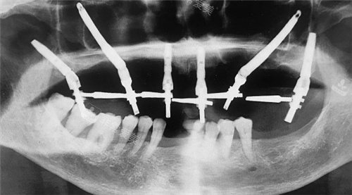 穿颧穿翼CT图示