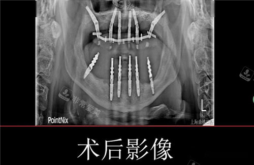 穿颧穿翼CT展示图