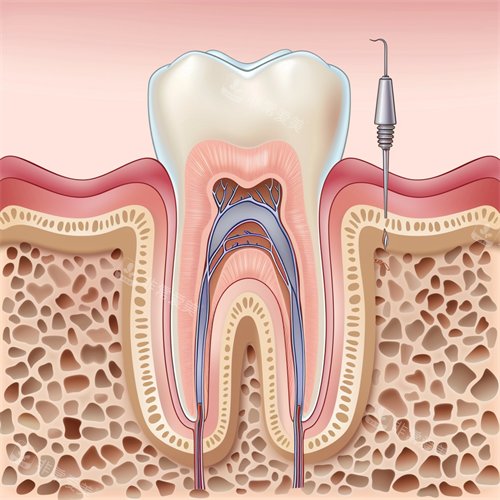 牙齿根管治疗漫画示意图