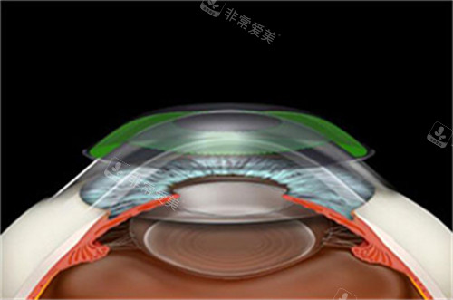 美国CRT角膜塑形镜原理展示