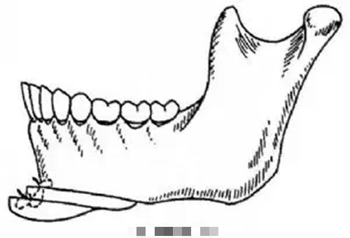 下颏截骨成型卡通示意图