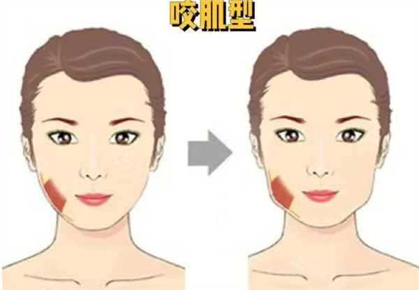 咬肌改善前后對(duì)比 咬肌改善前后對(duì)比