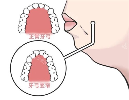 牙齿矫正扩牙弓目的