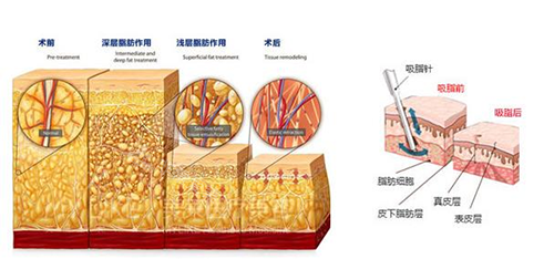 吸脂示意图