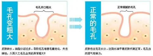 韩国皮肤科毛孔管理初体验!飞梭镭射让我皮肤光滑又细腻,再也不是插秧毛孔啦