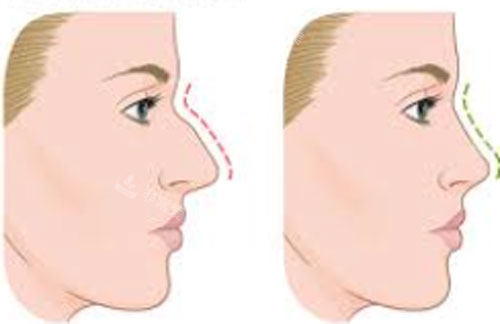 驼峰鼻矫正手术