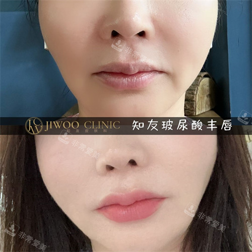 江南知友醫(yī)院玻尿酸豐唇前后對比圖 江南知友醫(yī)院玻尿酸豐唇前后對比圖