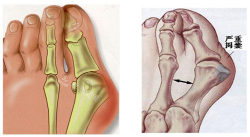 北京做大脚骨手术哪个医院好?圣嘉新整形/马文足科/美度医疗美容拇外翻矫正有名!