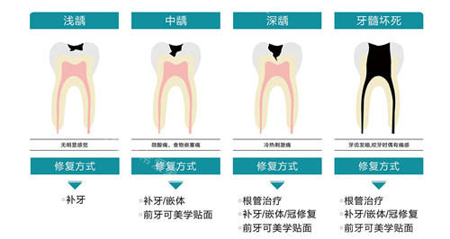 不同龋齿的修复方式