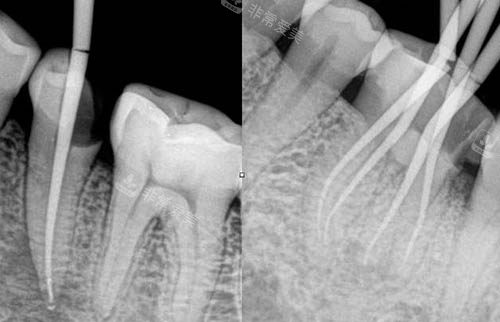 根管治疗ct照片