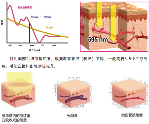 595激光功效