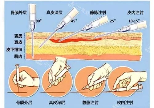 爱贝芙注射示意图