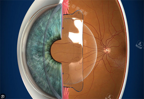 人工晶体植入图示