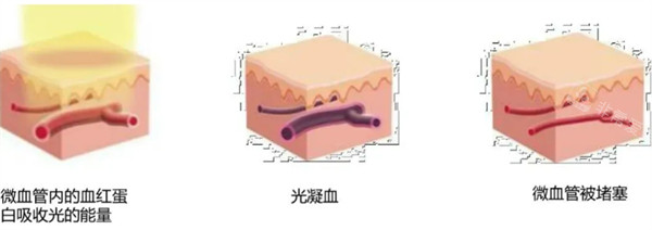 595激光工作原理 595激光工作原理
