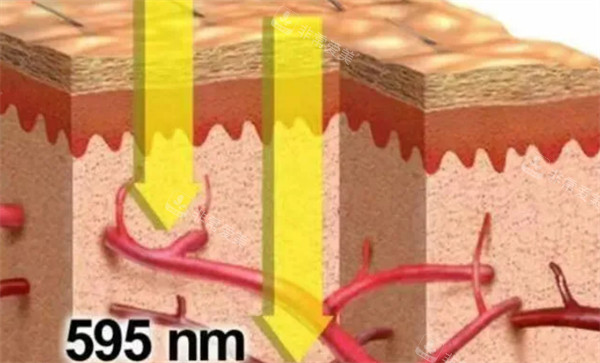 国内595染料激光哪个医院有?济南韩氏/杭州美莱/兰州时光/京城皮肤科都能做!
