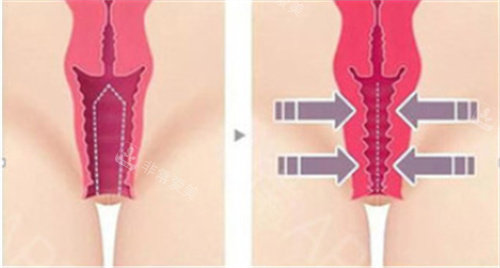 私密緊縮手術(shù)前后對比差異