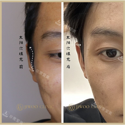 韓國知友醫(yī)院太陽穴填充前后對比