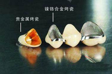 贵金属和镍洛合金烤瓷牙展示图
