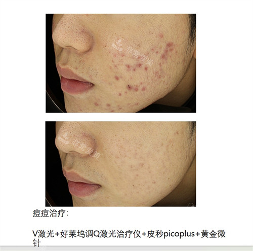 BTN皮膚科痘痘治療前后對比圖 BTN皮膚科痘痘治療前后對比圖
