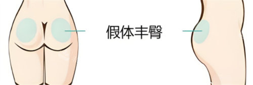 ​韩国假体丰臀技术怎么样，分享我在韩国做假体丰臀手术的经历！