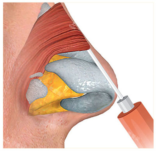 玻尿酸注射隆鼻過(guò)程圖
