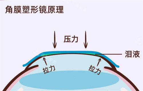 角膜塑形镜原理过程