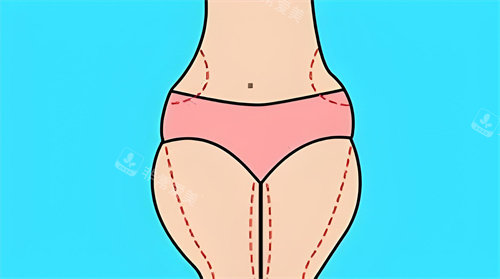 腿部吸脂手术吸脂部位动画图 腿部吸脂手术吸脂部位动画图
